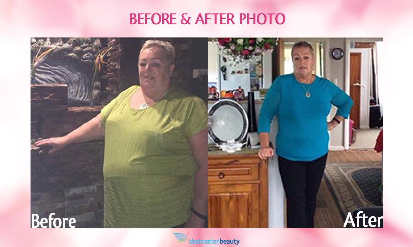 Gastric Sleeve Thailand Sharlene lost 45 kgs 1 year after gastric